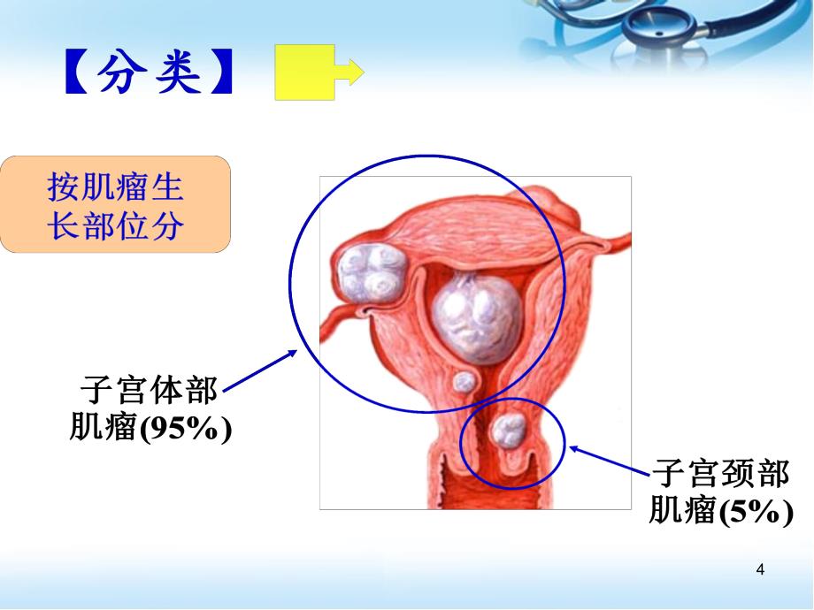 （优质课件）子宫肌瘤病人的术前术后护理_第4页