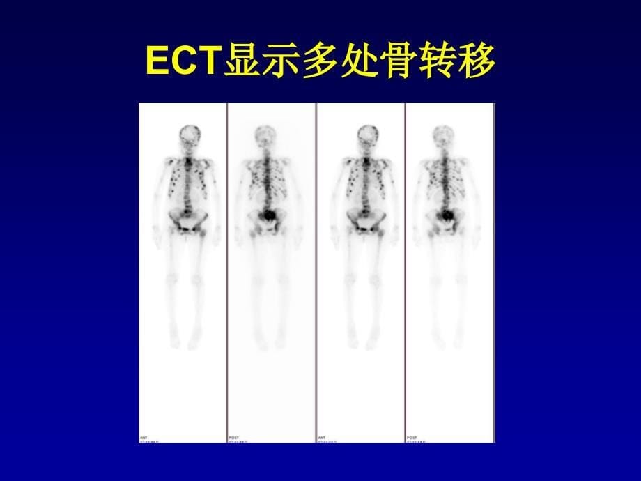 乳腺癌骨转移诊治进展_第5页