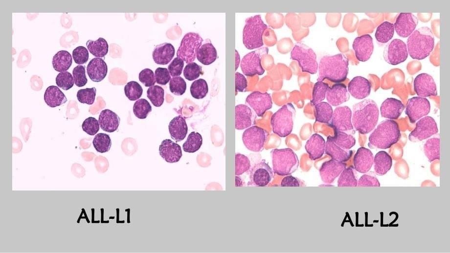 急性白血病分型及其特点_第5页