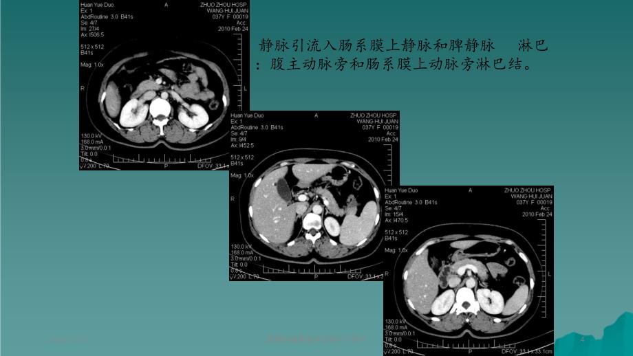 胰腺肿瘤影像学诊断2_第4页