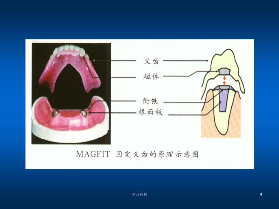 磁性附着体#学习资料_第4页