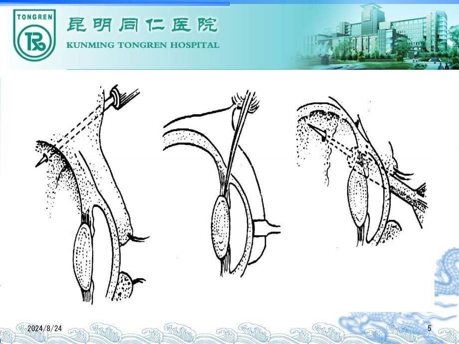 眼球穿通伤课件_第5页