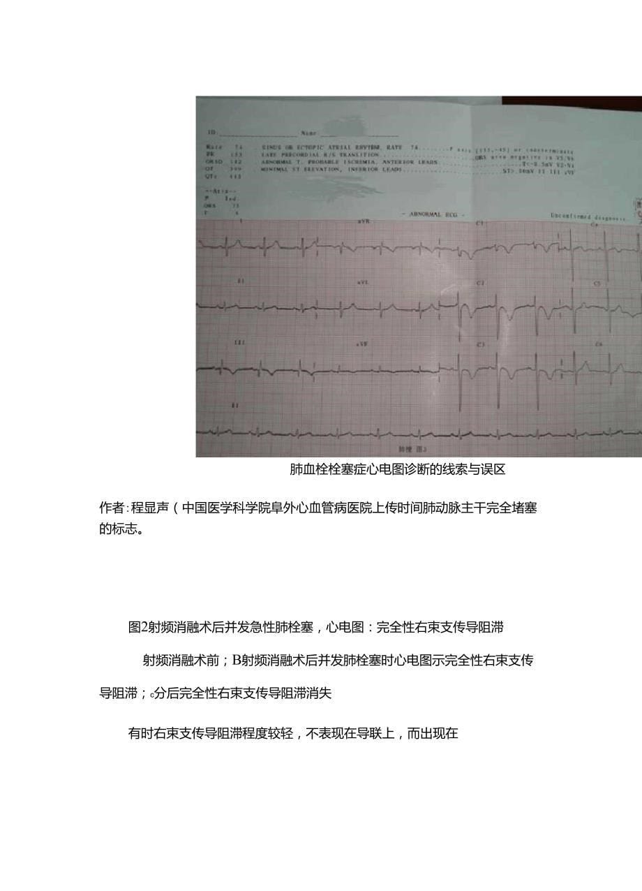 肺栓塞的心电图改变S1Q3T3_第5页