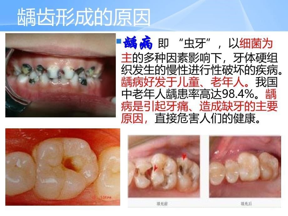 中老年人口腔保健ppt课件_第5页