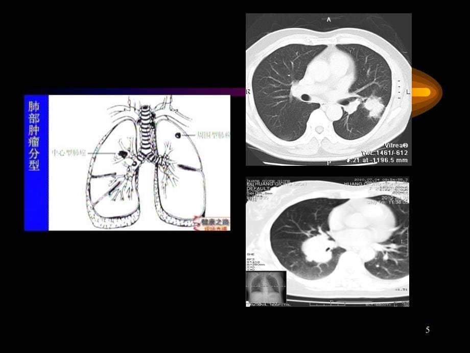 讲课肺癌英文ppt课件_第5页