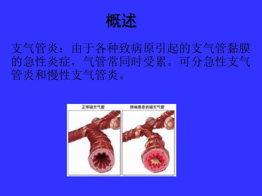 支气管炎护理.ppt_第4页