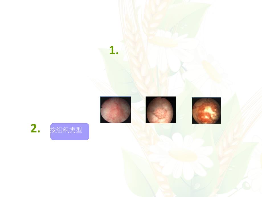 膀胱癌的护理ppt课件_第4页