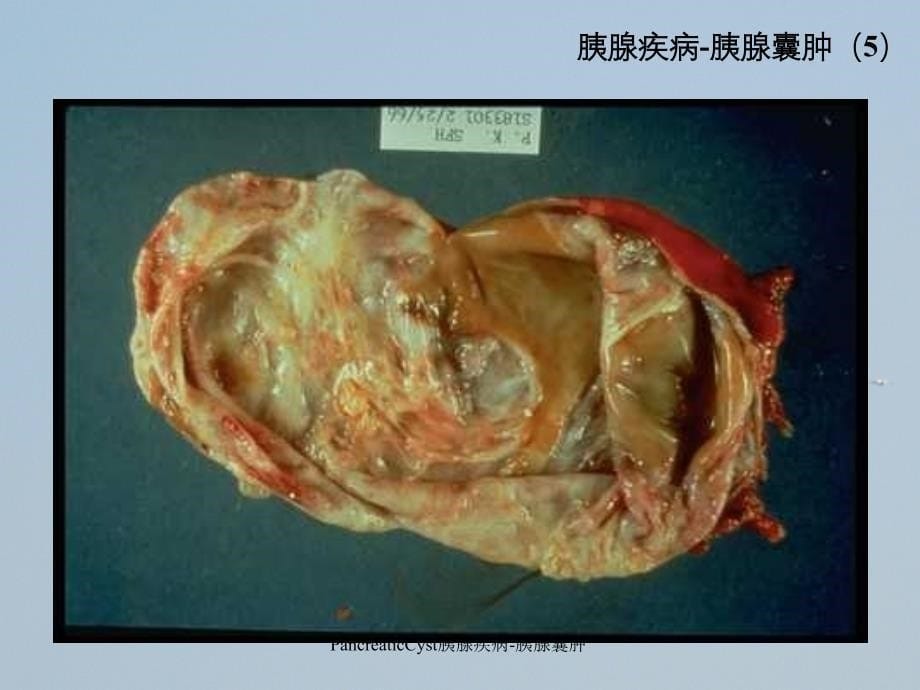 PancreaticCyst胰腺疾病胰腺囊肿_第5页