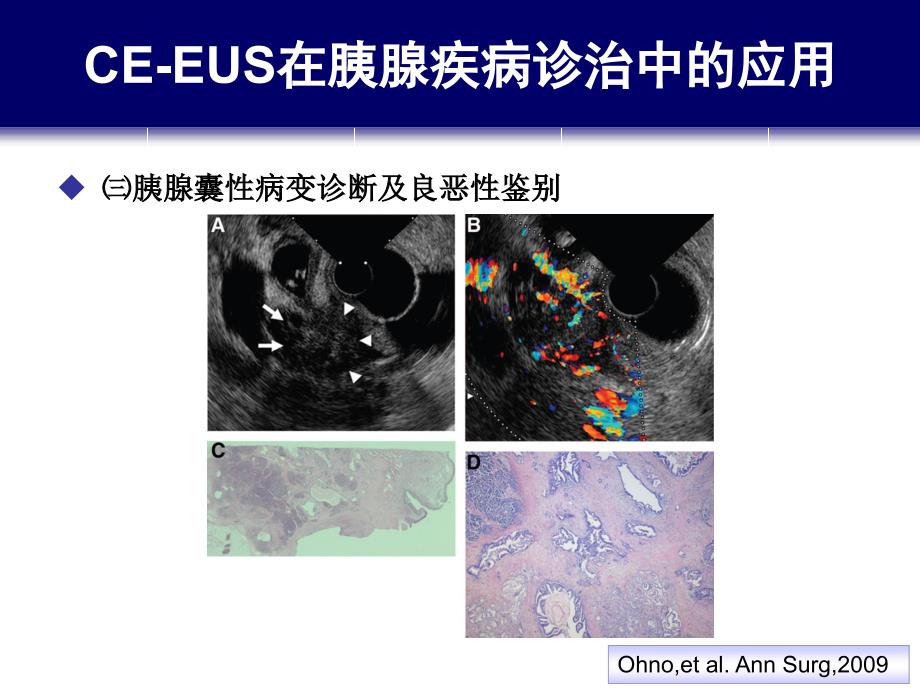 造影增强EUS与胰腺疾病诊治_第2页