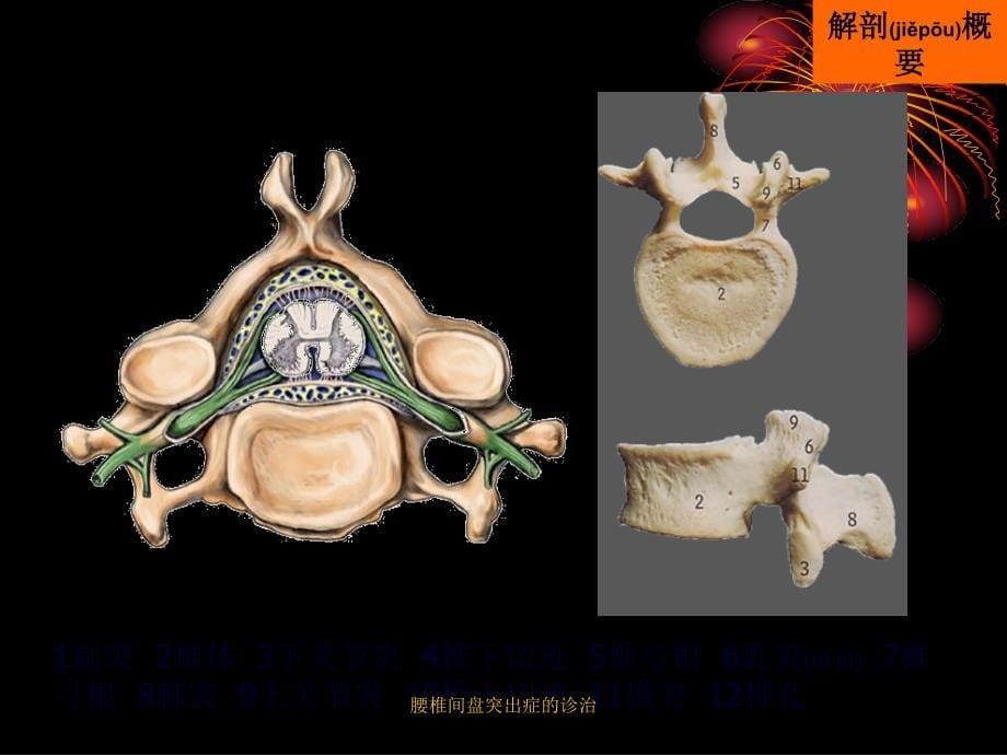 腰椎间盘突出症的诊治课件_第5页