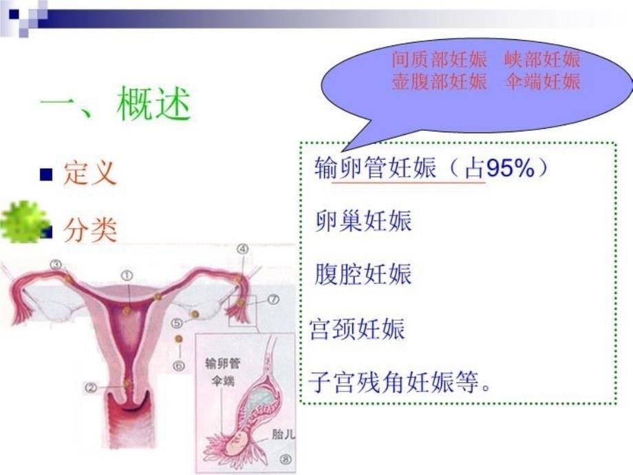 宫外孕的教学教材_第5页