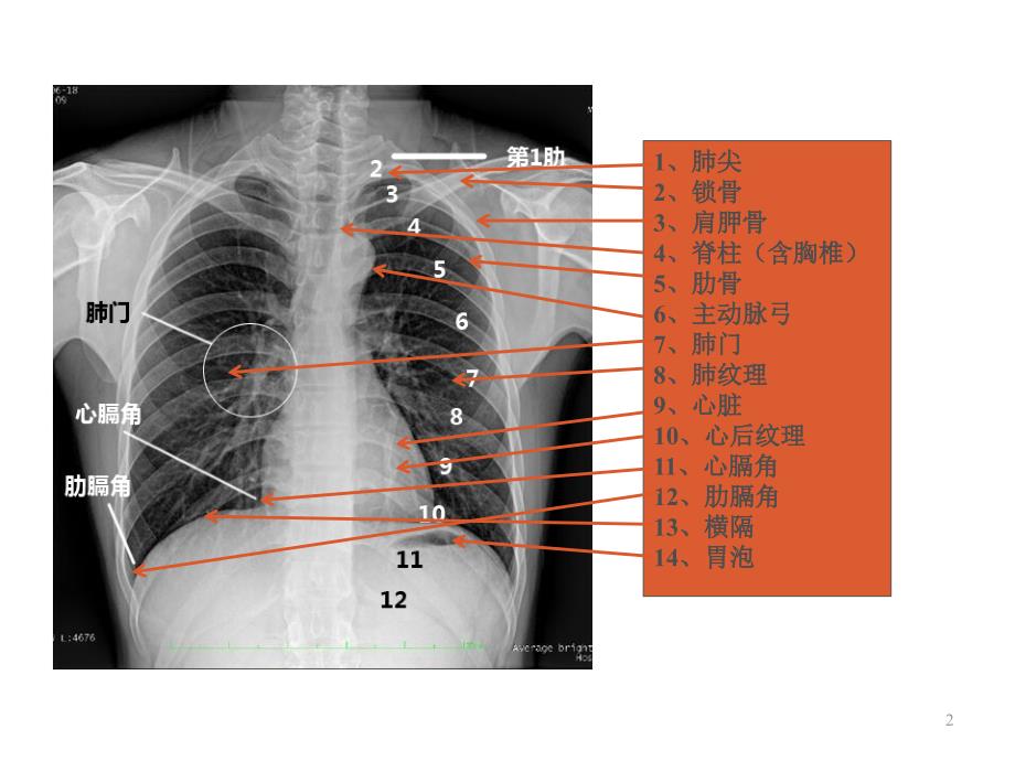 X光摄影的临床应用胸片分析和解读ppt课件_第2页