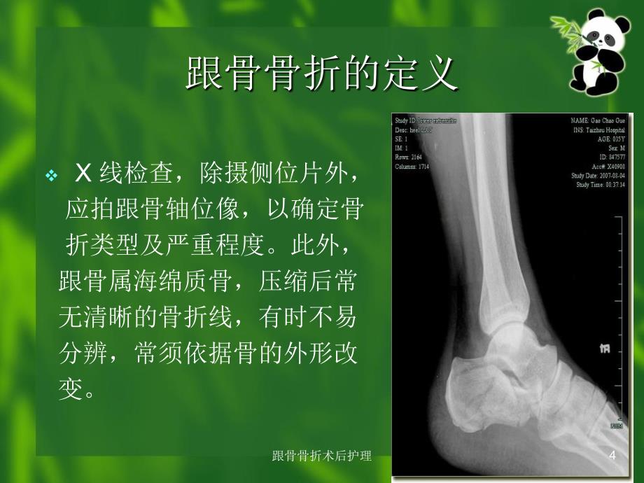 跟骨骨折术后护理课件_第4页