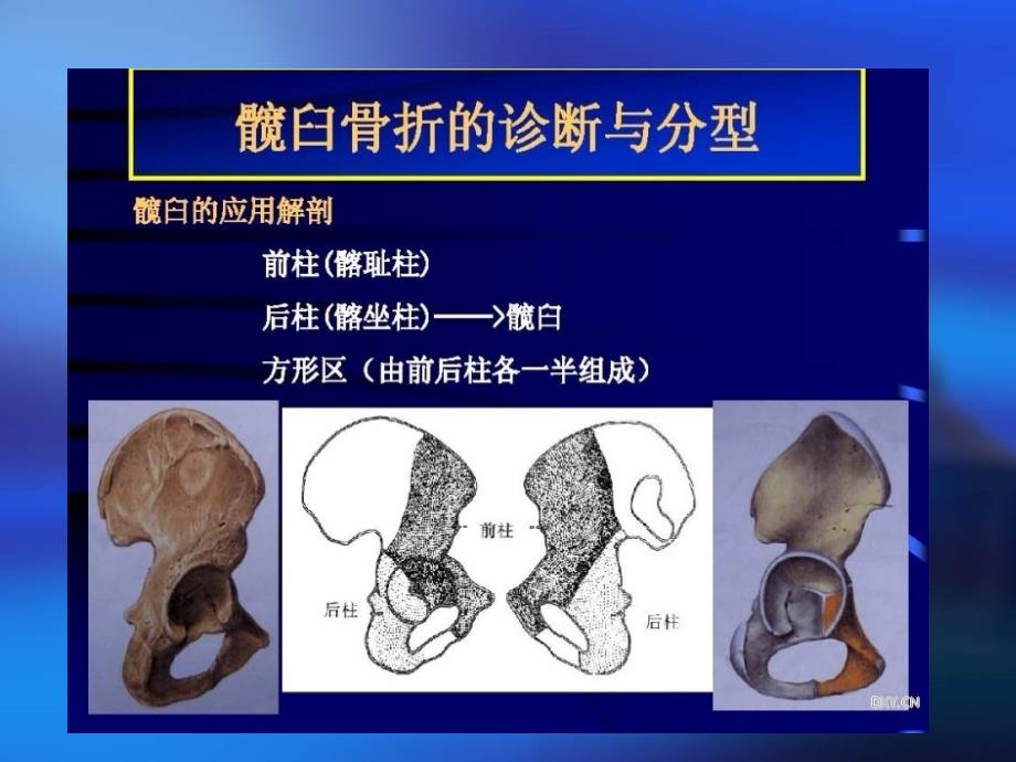 髋臼骨折的诊断及治疗ppt课件_第2页