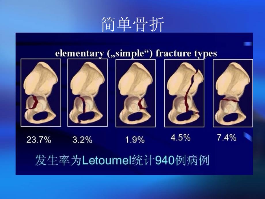 髋臼骨折的诊断及治疗ppt课件_第4页