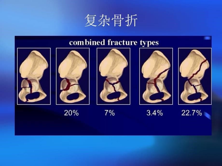 髋臼骨折的诊断及治疗ppt课件_第5页