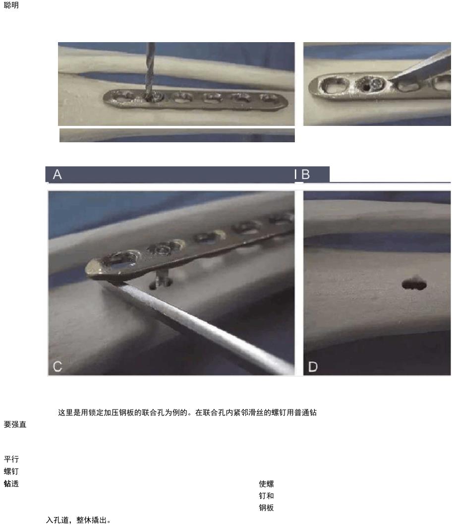 锁定滑丝螺钉取出绝招_第4页