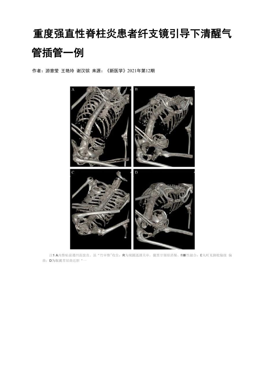 重度强直性脊柱炎患者纤支镜引导下清醒气管插管一例_第1页