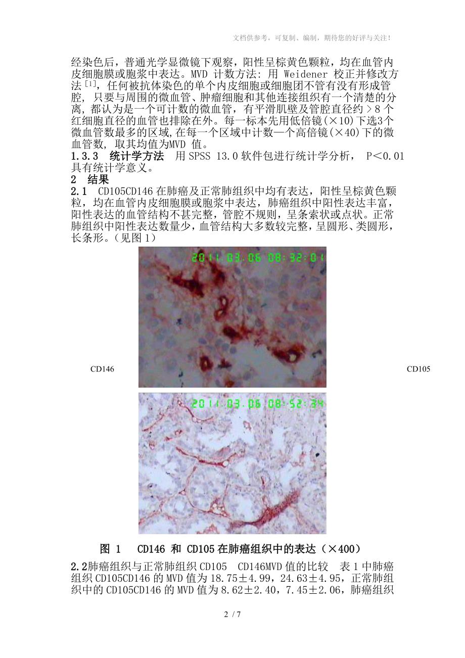 肺癌组织CD105、CD146的表达及临床意义_第2页