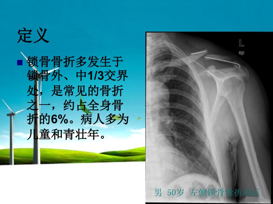 锁骨骨折的护理ppt课件_第2页