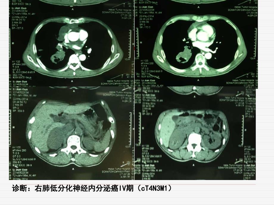 癌痛病例汇报_第4页