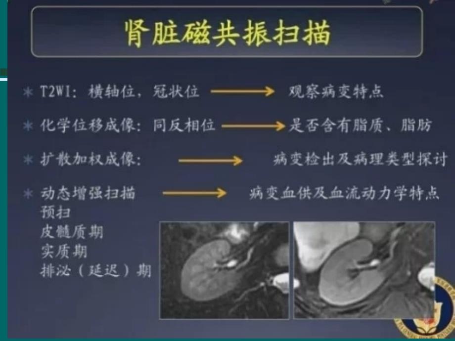 肾细胞癌MRI诊断及鉴别诊断PPT_第3页