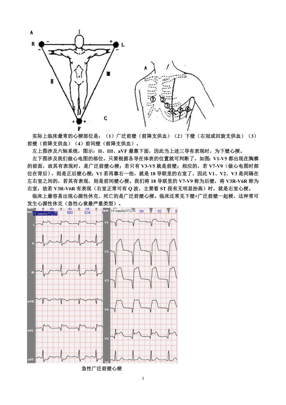 常见异常心电图及处理.doc_第3页