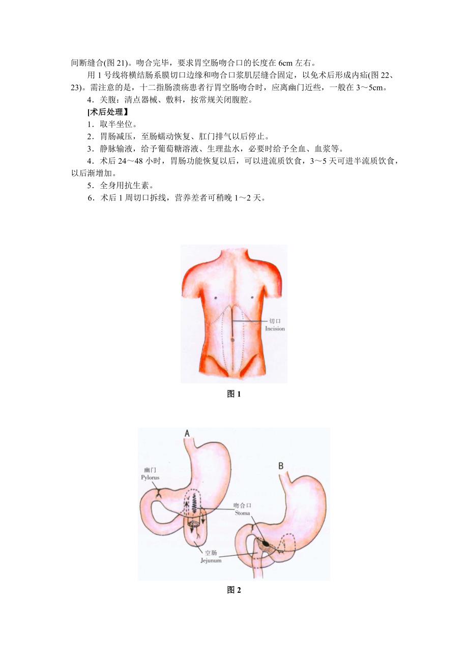 胃空肠吻合术_第2页