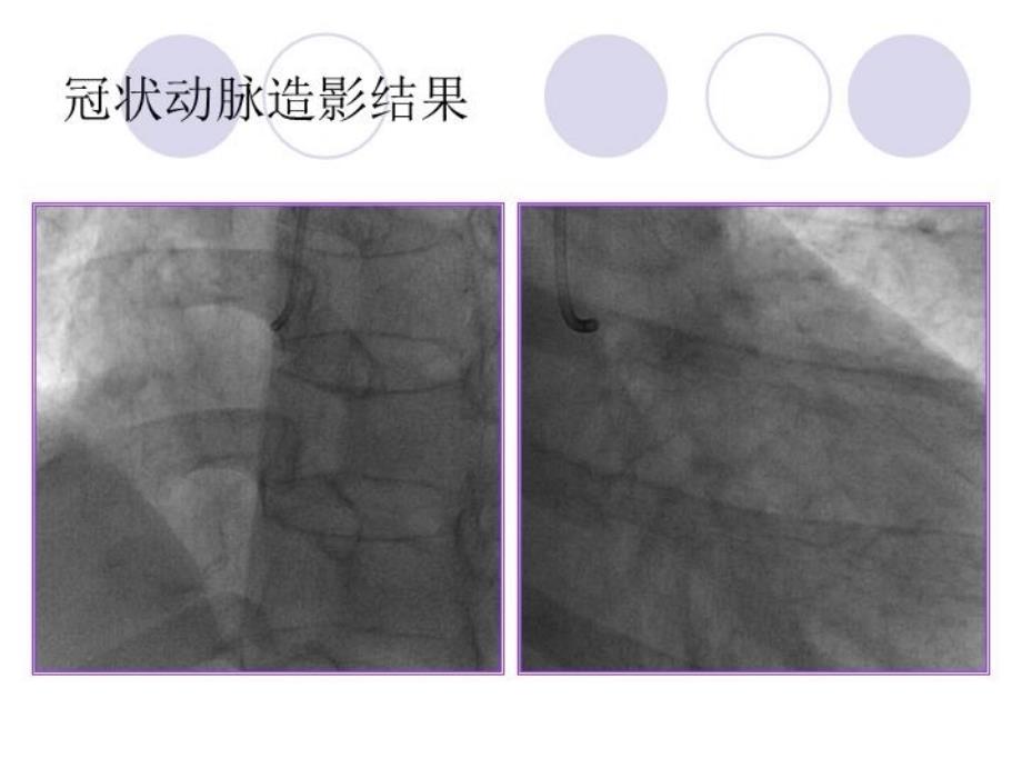 最新左主病变经桡动脉途径6FGC对吻支架术PPT课件_第3页