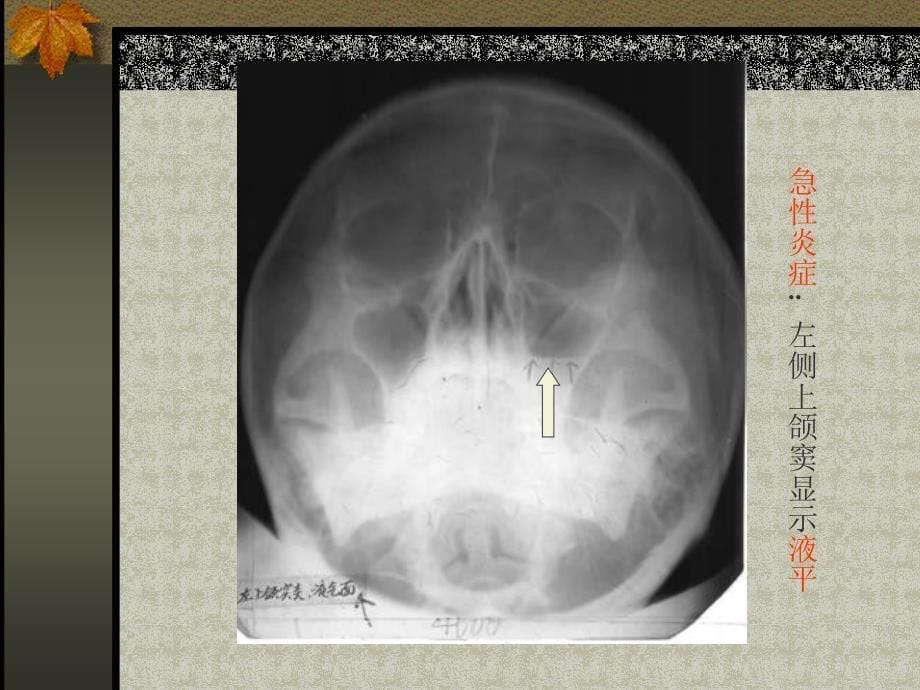 鼻副窦影像诊断PPT课件_第5页