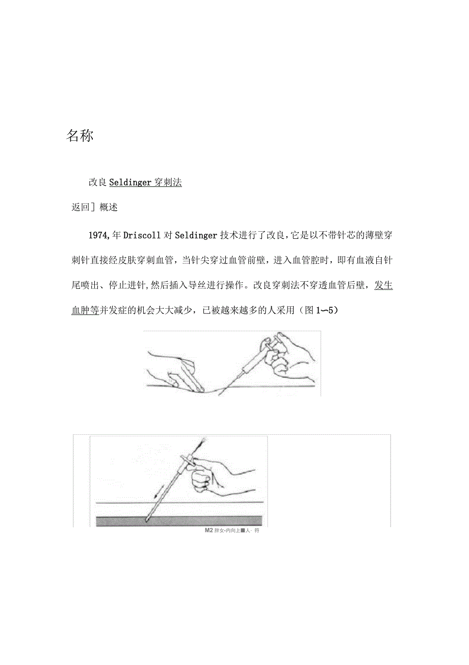 改良Seldinger穿刺法_第1页