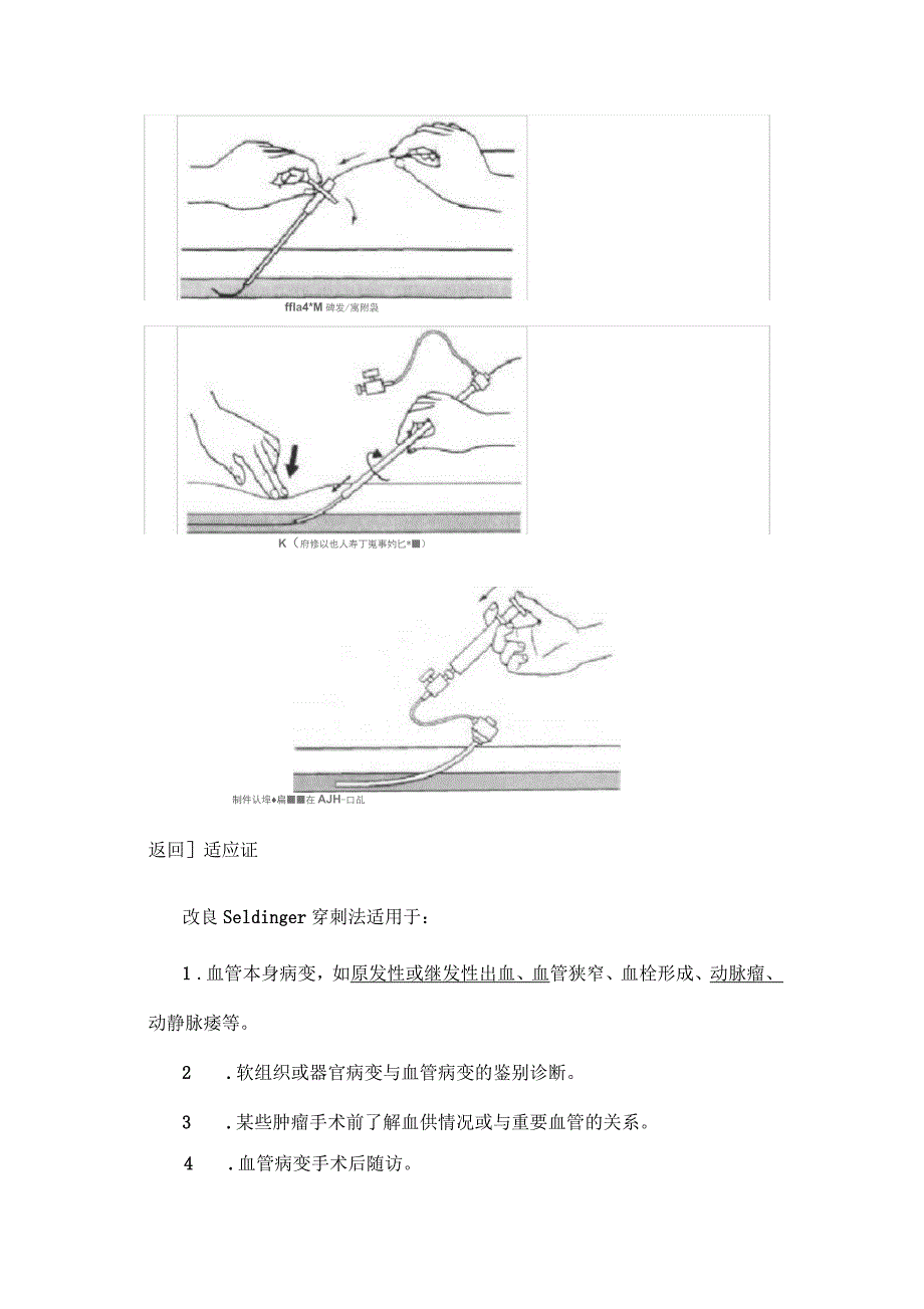 改良Seldinger穿刺法_第2页