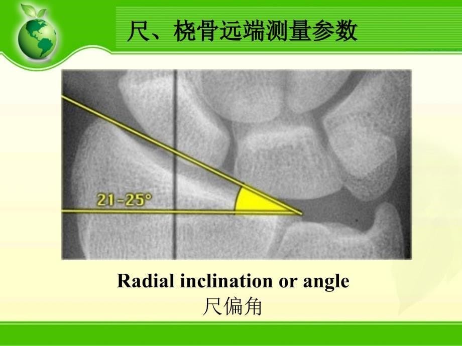 腕关节骨折PPT课件_第5页