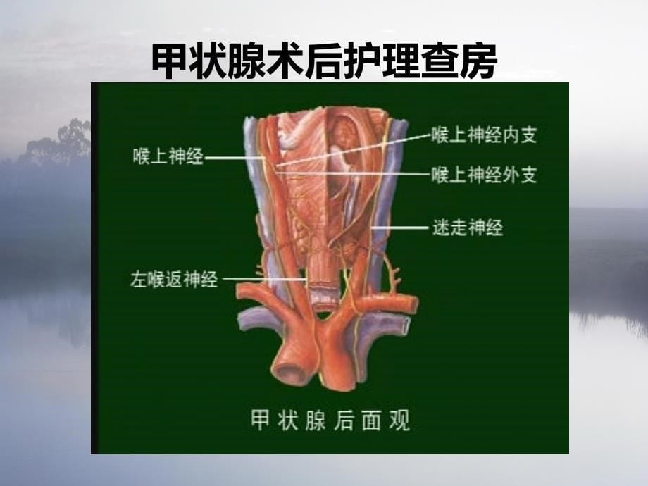 甲状腺术后护理查房-ppt课件_第5页