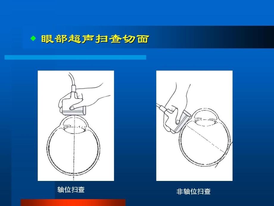 眼部B超常见病的图像及诊断.ppt_第4页