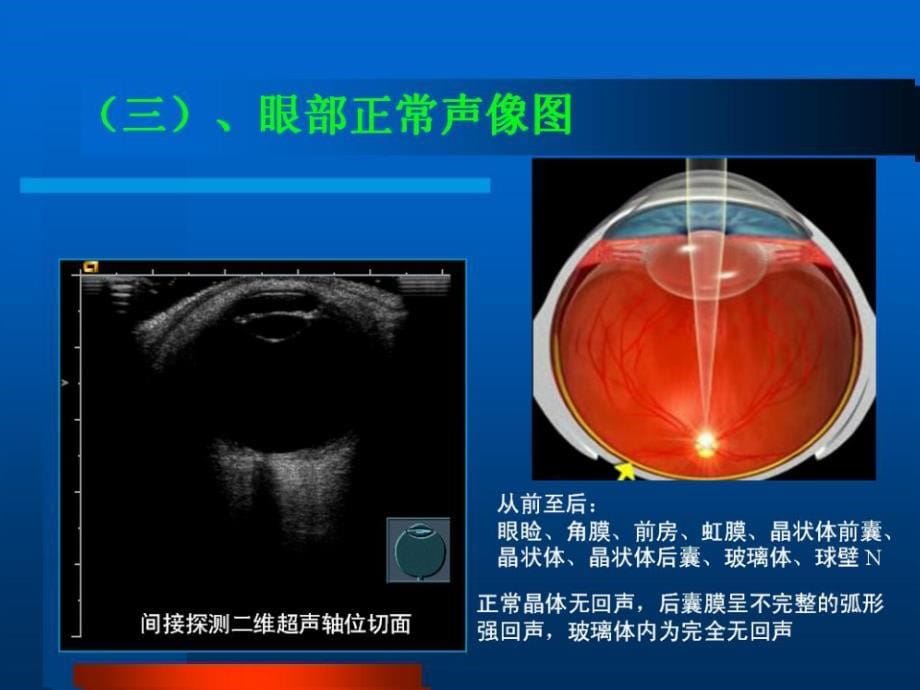 眼部B超常见病的图像及诊断.ppt_第5页