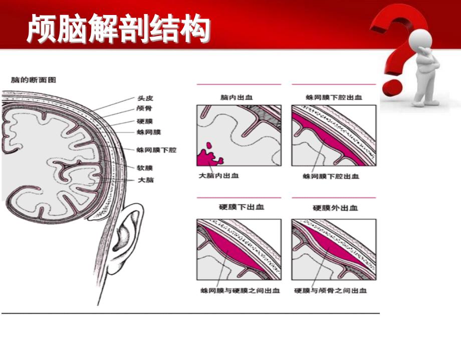 蛛网膜下腔出血的护理措施_第2页