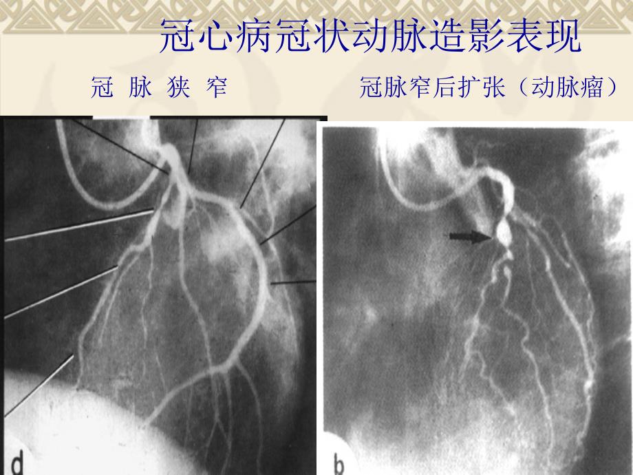 后天性心脏病的x线诊断4后心课件_第4页