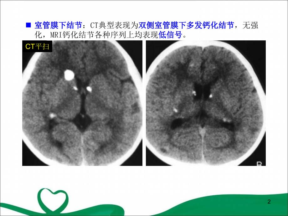 （优质课件）结节性硬化症_第2页