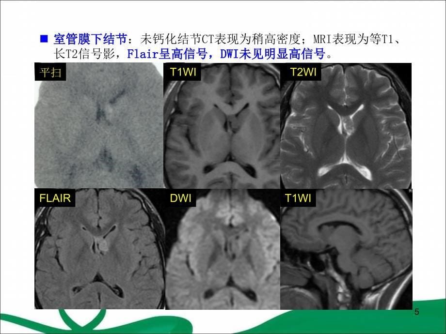 （优质课件）结节性硬化症_第5页