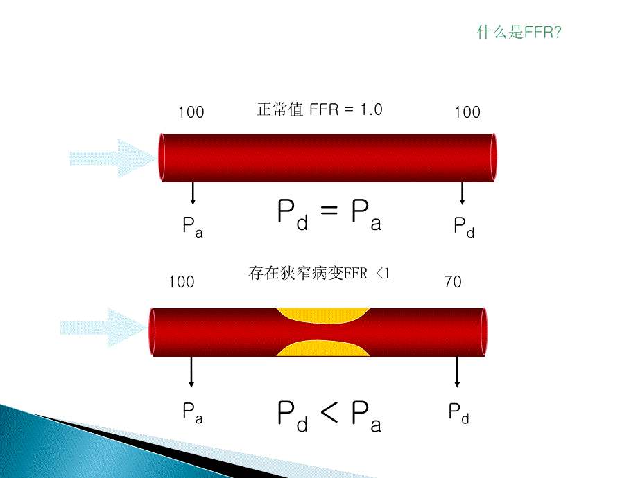 FFR-临床应用知识分享_第4页