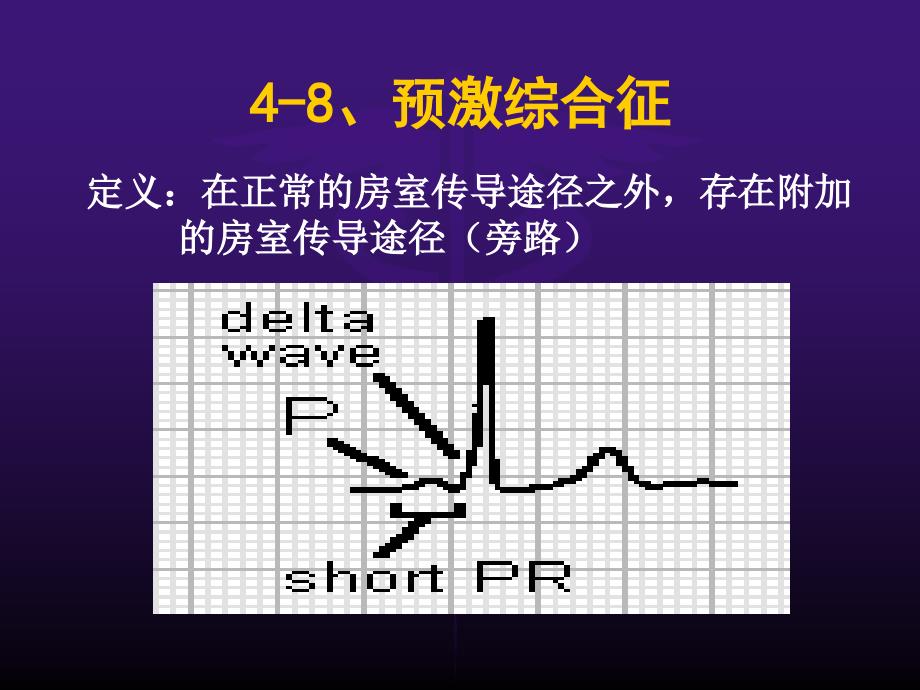 诊断学课件：诊断心电图心律失常4-8预激综合征和逸搏_第2页