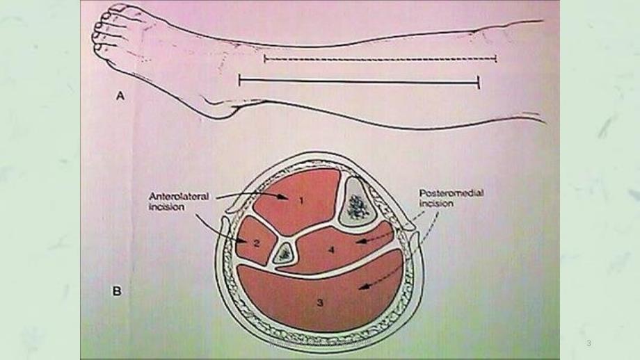 骨筋膜室综合征的观察与护理课件_第3页