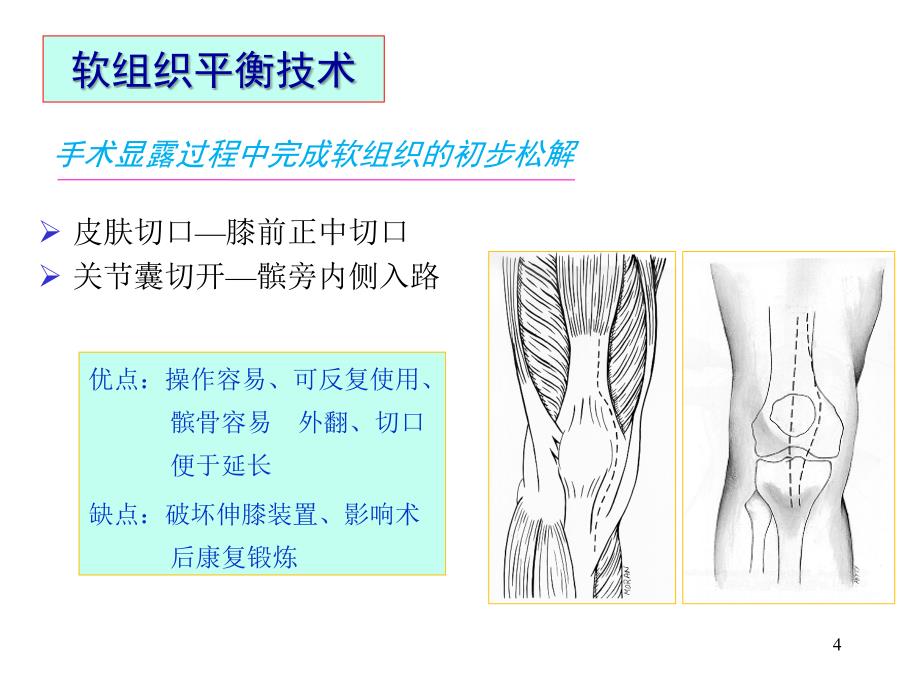 （推荐医学）人工膝关节置换的要点分析_第4页