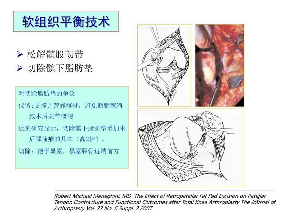 （推荐医学）人工膝关节置换的要点分析_第5页