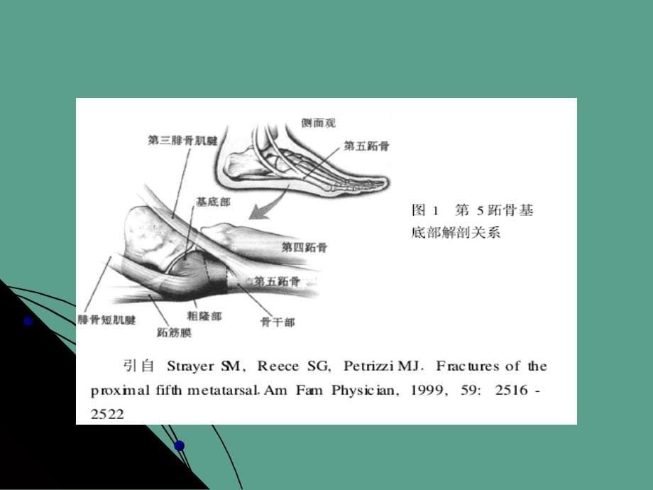 跖骨基底部骨折的分型与治疗ppt课件_第5页