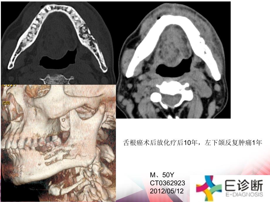 医学影像颌骨放射性骨坏死T表现_第1页