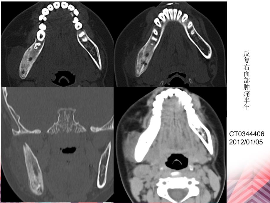 医学影像颌骨放射性骨坏死T表现_第2页