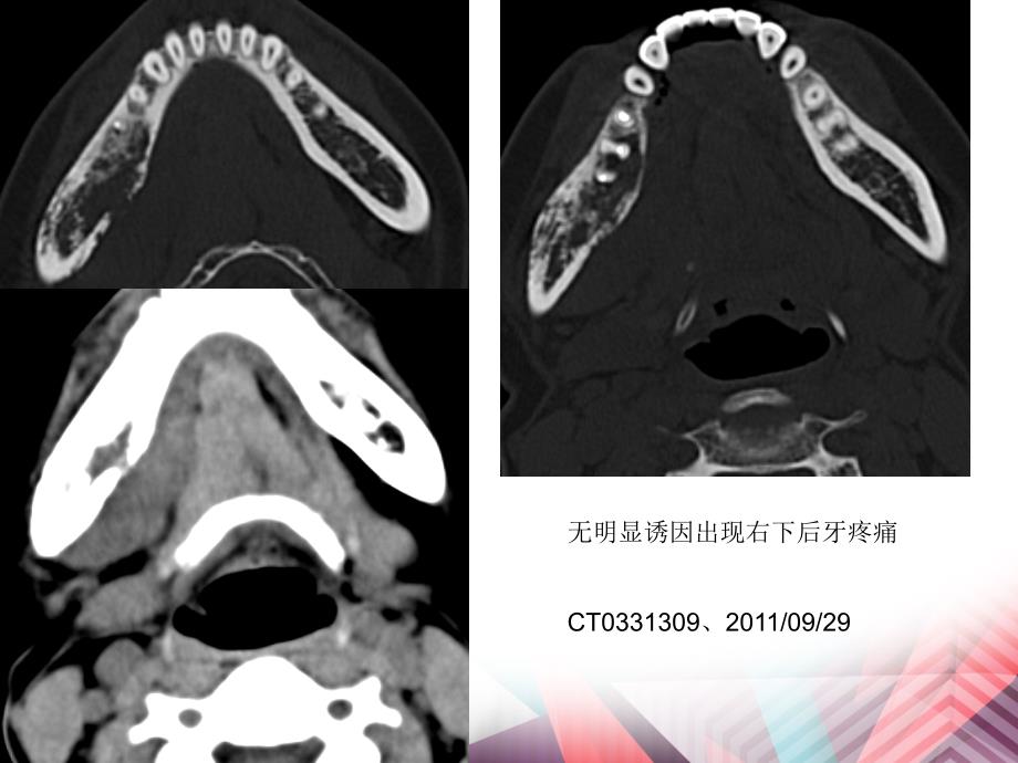 医学影像颌骨放射性骨坏死T表现_第3页