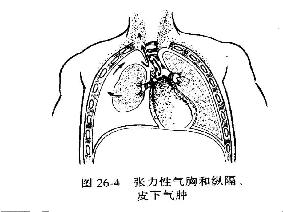 胸外科相关管路护_第5页